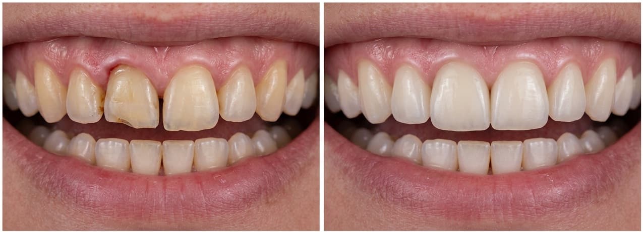Dental Implants