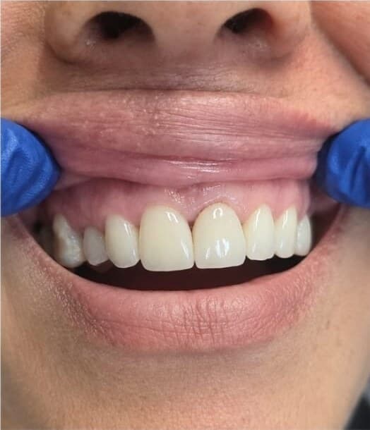 After — Before and after: patient with decayed, chipped and uneven upper front teeth, restored to bright, even, natural-looking front teeth.