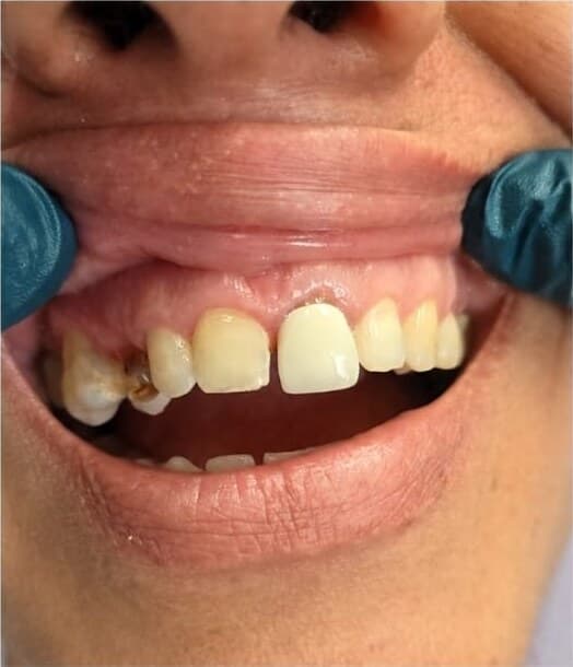 Before — Before and after: patient with decayed, chipped and uneven upper front teeth, restored to bright, even, natural-looking front teeth.